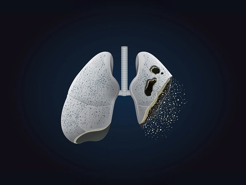 Use of Translational Biomarkers in Pulmonary Fibrosis