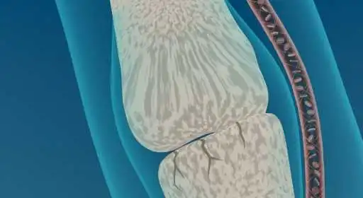 Joint Tissue Remodeling: Joint and Connective Tissue Disorder Profiling